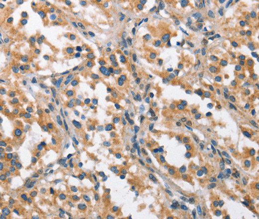 Immunohistochemistry of paraffin-embedded Human thyroid cancer using CHMP1A Polyclonal Antibody at dilution of 1:60