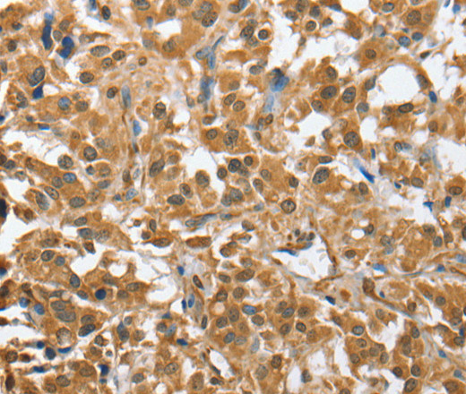 Immunohistochemistry of paraffin-embedded Human thyroid cancer tissue using CHMP4B Polyclonal Antibody at dilution 1:40