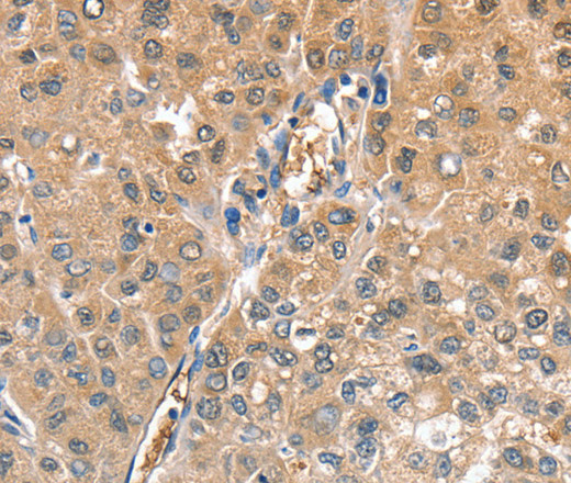 Immunohistochemistry of paraffin-embedded Human liver cancer using CIAPIN1 Polyclonal Antibody at dilution of 1:60