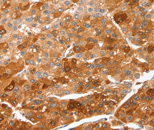 Immunohistochemistry of paraffin-embedded Human liver cancer using CIDEC Polyclonal Antibody at dilution of 1:50