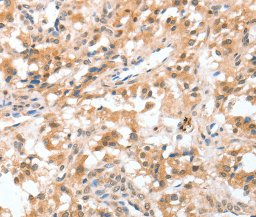 Immunohistochemistry of paraffin-embedded Human thyroid cancer using CIDEC Polyclonal Antibody at dilution of 1:50