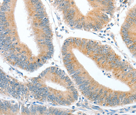 Immunohistochemistry of paraffin-embedded Human colon cancer tissue using CKAP2 Polyclonal Antibody at dilution 1:50