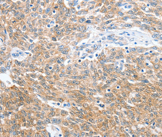 Immunohistochemistry of paraffin-embedded Human ovarian cancer tissue using CKAP2 Polyclonal Antibody at dilution 1:50