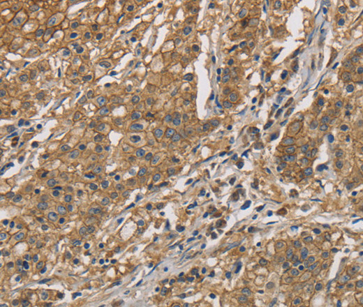 Immunohistochemistry of paraffin-embedded Human gastic cancer using CKMT2 Polyclonal Antibody at dilution of 1:60