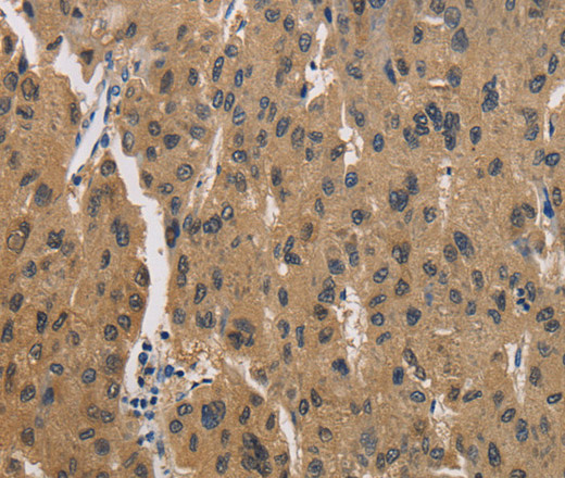 Immunohistochemistry of paraffin-embedded Human liver cancer using CKMT2 Polyclonal Antibody at dilution of 1:60