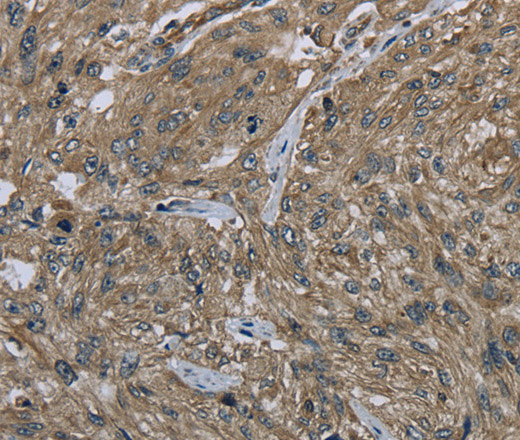 Immunohistochemistry of paraffin-embedded Human esophagus cancer tissue using CLPS Polyclonal Antibody at dilution 1:40