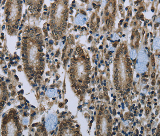 Immunohistochemistry of paraffin-embedded Human gastric cancer tissue using CLPS Polyclonal Antibody at dilution 1:40