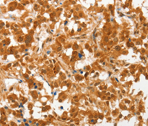 Immunohistochemistry of paraffin-embedded Human thyroid cancer tissue using COL4A3BP Polyclonal Antibody at dilution 1:50