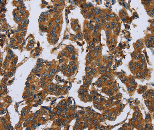 Immunohistochemistry of paraffin-embedded Human breast cancer tissue using COMP Polyclonal Antibody at dilution 1:50