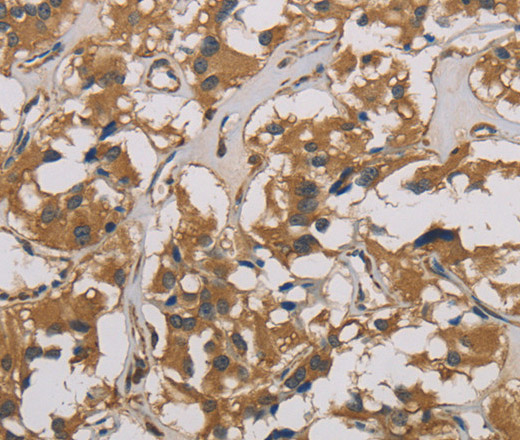 Immunohistochemistry of paraffin-embedded Human thyroid cancer using CORO1C Polyclonal Antibody at dilution of 1:50