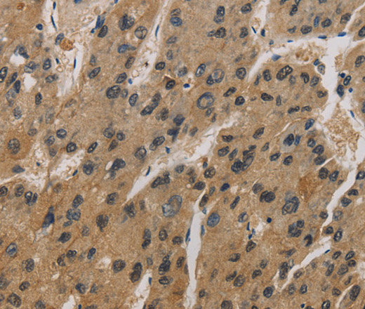 Immunohistochemistry of paraffin-embedded Human liver cancer using CORO1C Polyclonal Antibody at dilution of 1:50