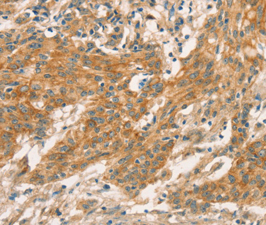 Immunohistochemistry of paraffin-embedded Human gastric cancer tissue using CPA2 Polyclonal Antibody at dilution 1:40