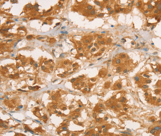 Immunohistochemistry of paraffin-embedded Human thyroid cancer tissue using CPB1 Polyclonal Antibody at dilution of 1:50