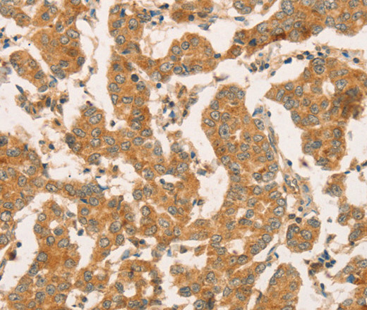 Immunohistochemistry of paraffin-embedded Human breast cancer using CPB1 Polyclonal Antibody at dilution of 1:50