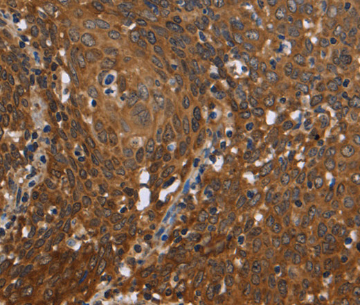 Immunohistochemistry of paraffin-embedded Human cervical cancer using c-Rel Polyclonal Antibody at dilution of 1:50