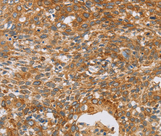 Immunohistochemistry of paraffin-embedded Human cervical cancer using CRELD2 Polyclonal Antibody at dilution of 1:40