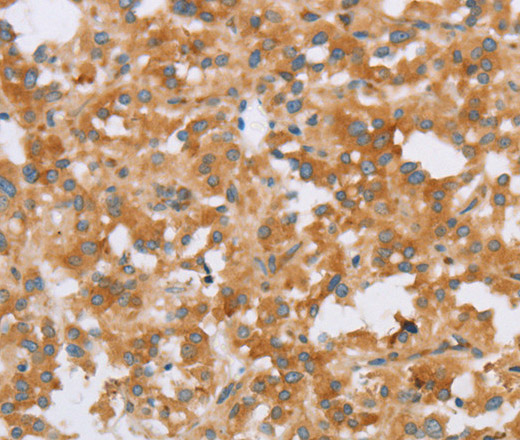 Immunohistochemistry of paraffin-embedded Human thyroid cancer using CRELD2 Polyclonal Antibody at dilution of 1:40