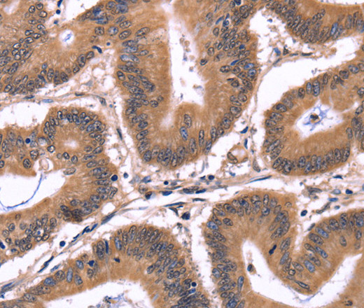 Immunohistochemistry of paraffin-embedded Human colon cancer tissue using CRK Polyclonal Antibody at dilution 1:50