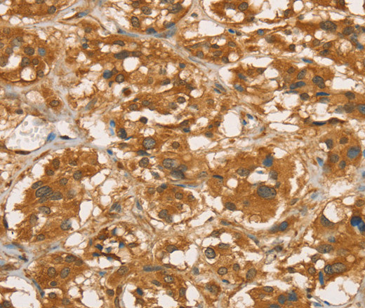 Immunohistochemistry of paraffin-embedded Human thyroid cancer tissue using RBBP8 Polyclonal Antibody at dilution 1:45