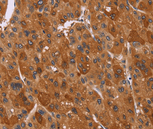 Immunohistochemistry of paraffin-embedded Human liver cancer tissue using CTNNBL1 Polyclonal Antibody at dilution 1:50