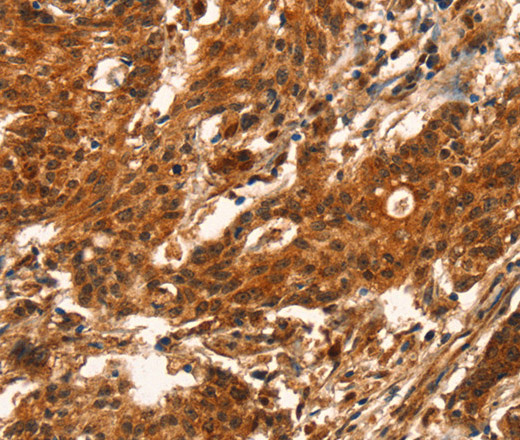 Immunohistochemistry of paraffin-embedded Human gastric cancer using CUEDC2 Polyclonal Antibody at dilution of 1:50