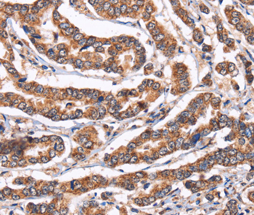 Immunohistochemistry of paraffin-embedded Human breast cancer using Cyclophilin F Polyclonal Antibody at dilution of 1:60