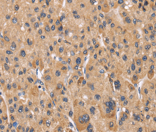 Immunohistochemistry of paraffin-embedded Human liver cancer using Cyclophilin F Polyclonal Antibody at dilution of 1:60