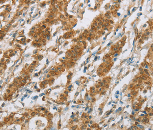 Immunohistochemistry of paraffin-embedded Human gastric cancer using CYP2E1 Polyclonal Antibody at dilution of 1:30