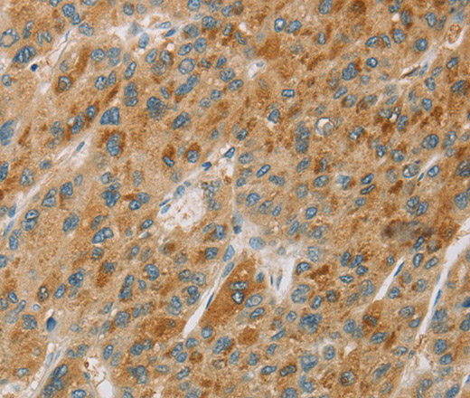 Immunohistochemistry of paraffin-embedded Human liver cancer tissue using CYP11B1 Polyclonal Antibody at dilution 1:30