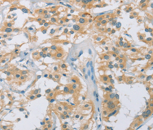 Immunohistochemistry of paraffin-embedded Human thyroid cancer tissue using CYP11B1 Polyclonal Antibody at dilution 1:30