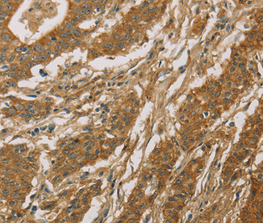 Immunohistochemistry of paraffin-embedded Human gasrtic cancer tissue using CYP39A1 Polyclonal Antibody at dilution 1:50