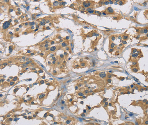 Immunohistochemistry of paraffin-embedded Human thyroid cancer using CYR61 Polyclonal Antibody at dilution of 1:50