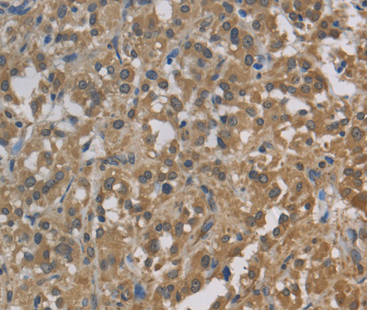 Immunohistochemistry of paraffin-embedded Human thyroid cancer using Cytochrome b5 Polyclonal Antibody at dilution of 1:30