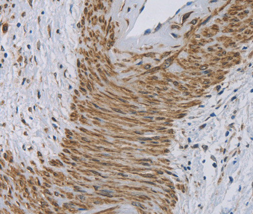 Immunohistochemistry of paraffin-embedded Human cervical cancer using Cytochrome b5 Polyclonal Antibody at dilution of 1:30