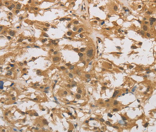 Immunohistochemistry of paraffin-embedded Human thyroid cancer using DAB2 Polyclonal Antibody at dilution of 1:30