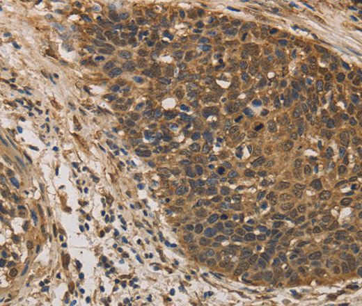 Immunohistochemistry of paraffin-embedded Human cervical cancer tissue using DACH1 Polyclonal Antibody at dilution 1:50