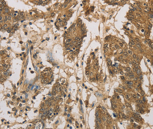 Immunohistochemistry of paraffin-embedded Human colon cancer tissue using DACH1 Polyclonal Antibody at dilution 1:50