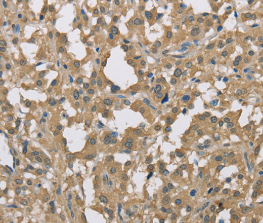 Immunohistochemistry of paraffin-embedded Human thyroid cancer tissue using DACH2 Polyclonal Antibody at dilution 1:40