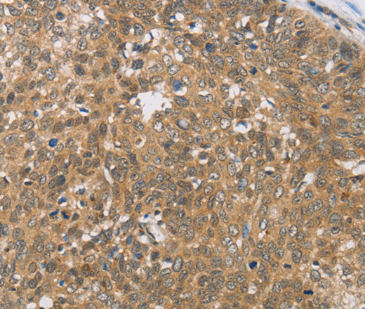 Immunohistochemistry of paraffin-embedded Human cervical cancer tissue using DIO1 Polyclonal Antibody at dilution 1:50