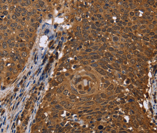 Immunohistochemistry of paraffin-embedded Human cervical cancer using DCP1A Polyclonal Antibody at dilution of 1:50