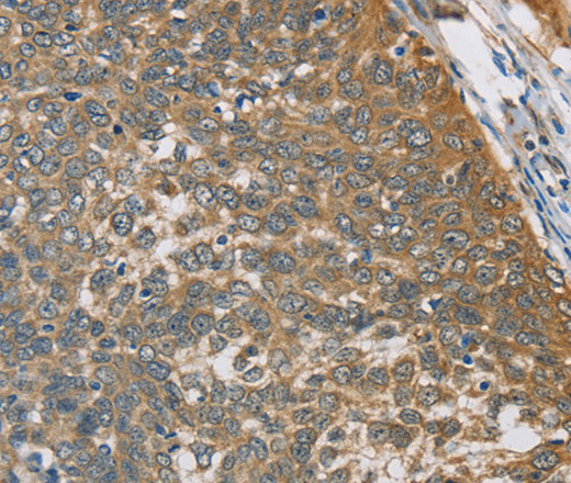 Immunohistochemistry of paraffin-embedded Human cervical cancer tissue using TNFRSF10D Polyclonal Antibody at dilution 1:40