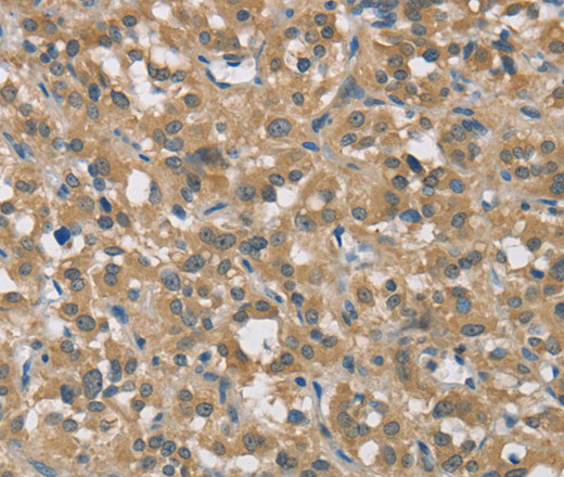 Immunohistochemistry of paraffin-embedded Human thyroid cancer tissue using TNFRSF10D Polyclonal Antibody at dilution 1:40