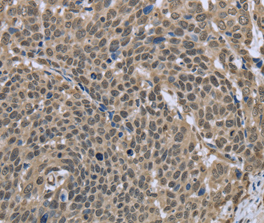 Immunohistochemistry of paraffin-embedded Human cervical cancer tissue using DCTN4 Polyclonal Antibody at dilution 1:30