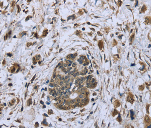 Immunohistochemistry of paraffin-embedded Human breast cancer tissue using DCTN4 Polyclonal Antibody at dilution 1:30