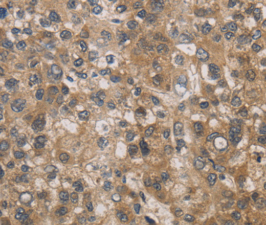 Immunohistochemistry of paraffin-embedded Human liver cancer tissue using DEGS1 Polyclonal Antibody at dilution 1:30