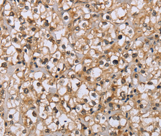 Immunohistochemistry of paraffin-embedded Human prostate cancer tissue using DLD Polyclonal Antibody at dilution 1:35