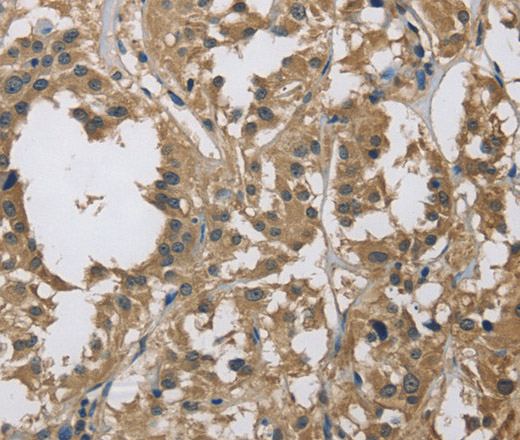 Immunohistochemistry of paraffin-embedded Human thyroid cancer tissue using DSG2 Polyclonal Antibody at dilution 1:70