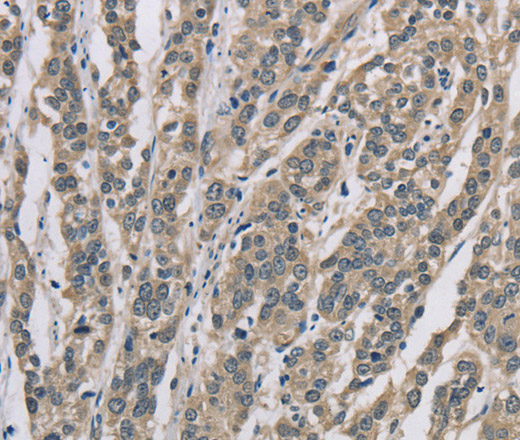 Immunohistochemistry of paraffin-embedded Human esophagus cancer tissue using DSG2 Polyclonal Antibody at dilution 1:70