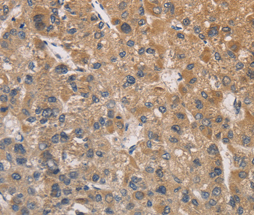 Immunohistochemistry of paraffin-embedded Human liver cancer tissue using DSTN Polyclonal Antibody at dilution 1:30