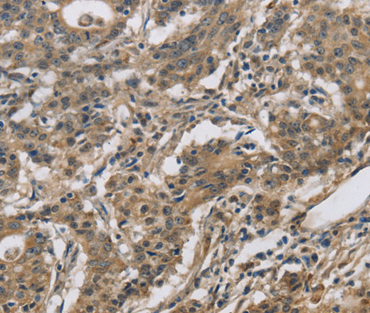 Immunohistochemistry of paraffin-embedded Human gastic cancer using DHRS3 Polyclonal Antibody at dilution of 1:30